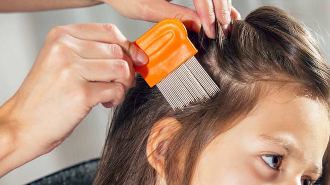 Best Ways to Treat Head Lice